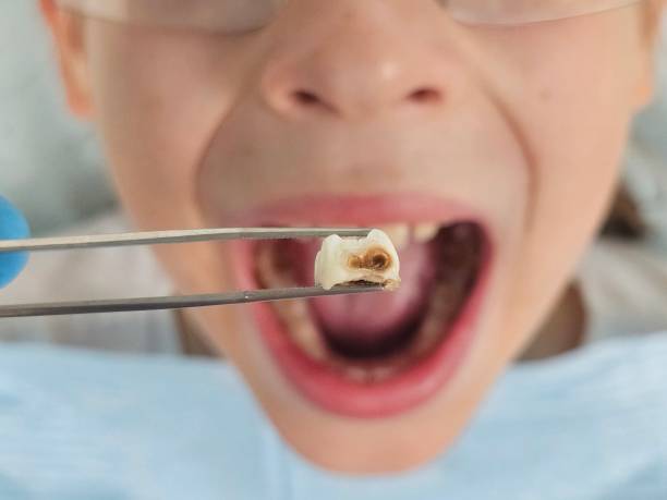 Best Knocked-Out Tooth (Avulsed Tooth) Treatment in River Edge, NJ